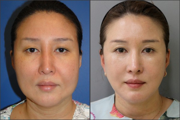 Nose Surgery, Face Lift - facelift , septal rhinoplasty