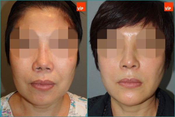 Nose Surgery, Face Lift - Rib cartilage rhinoplasty