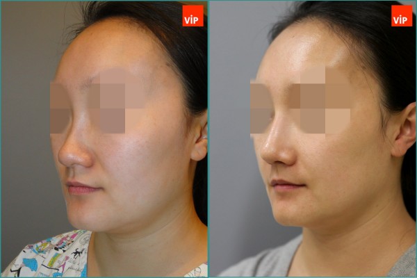 Nose Surgery - Septal cartilage rhinoplasty