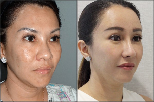 Nose Surgery, Face Lift, Stem Cell Fat Graft - Rib cartilage Rhinoplasty, Endoscopic Forehead Lift, Fat graft, Lateral Canthoplasty