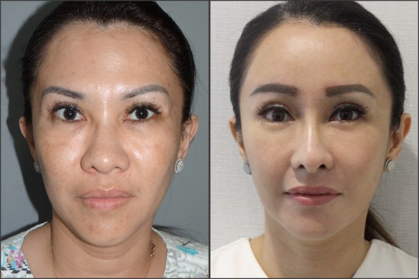 Nose Surgery, Face Lift, Stem Cell Fat Graft - Rib cartilage Rhinoplasty, Endoscopic Forehead Lift, Fat graft, Lateral Canthoplasty