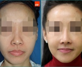 Rhinoplasty