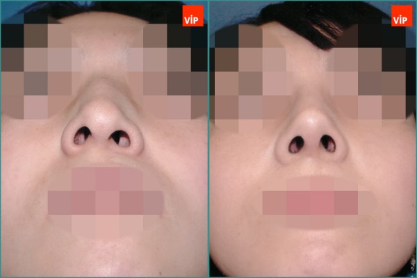 Nose Surgery - Hump Nose Septal cartilage rhinoplasty