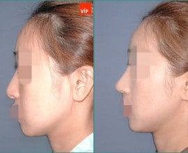 Septal cartilage rhinoplasty