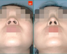 Septal cartilage rhinoplasty