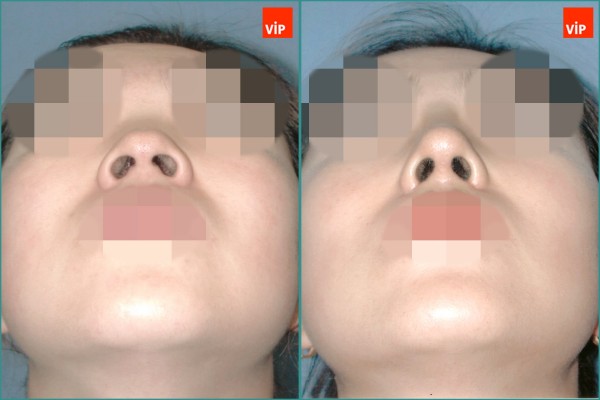 Nose Surgery - Septal cartilage rhinoplasty