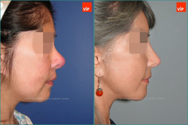 Nose Surgery - Face lift / Revision rhinoplasty / Rib cartilage rhinoplasty