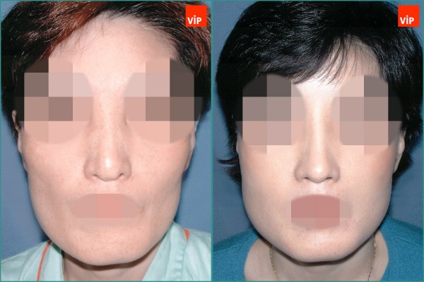 Nose Surgery - Rib cartilage rhinoplasty