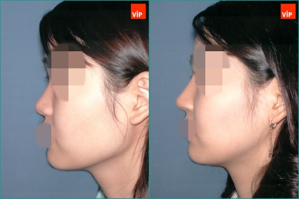 Nose Surgery - Septal cartilage rhinoplasty