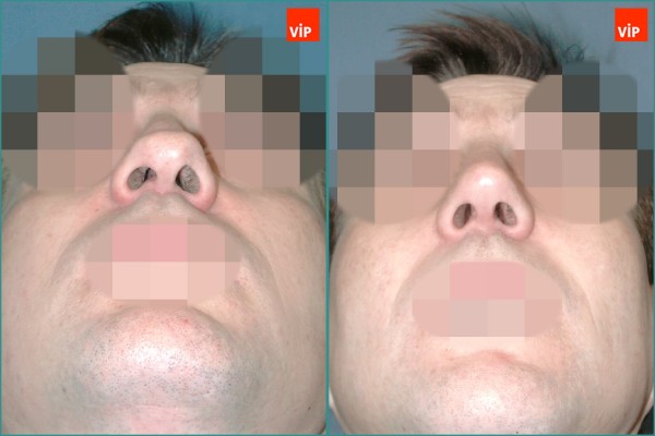 Nose Surgery - Hump Nose Septal cartilage rhinoplasty, Mid Face Augmentation