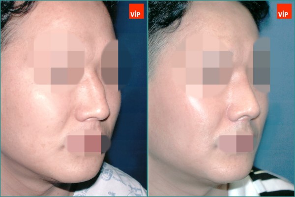 Nose Surgery - Deviated nose