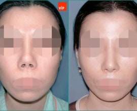 Contracted nose / Rib cartilage rhinoplasty