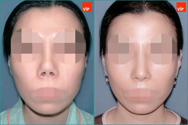 Nose Surgery - Contracted nose / Rib cartilage rhinoplasty