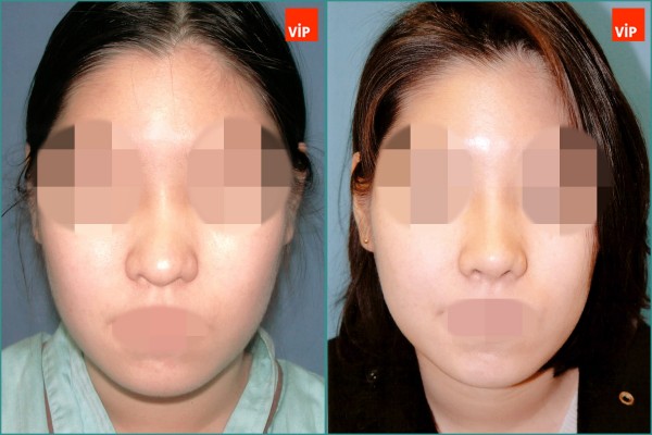 Nose Surgery - Septal cartilage rhinoplasty