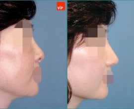 Septal cartilage rhinoplasty