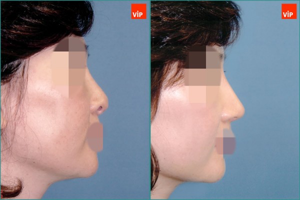 Nose Surgery - Septal cartilage rhinoplasty