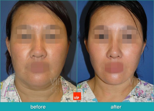 Face Lift - High SMAS Face / Necklift