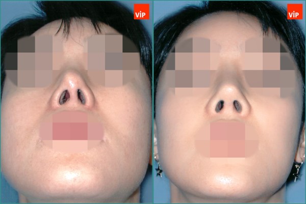 Nose Surgery - Rib cartilage rhinoplasty