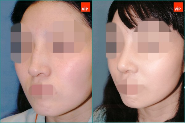 Nose Surgery - Hump Nose Septal cartilage rhinoplasty