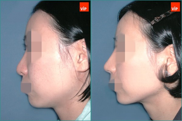 Nose Surgery - Septal cartilage rhinoplasty