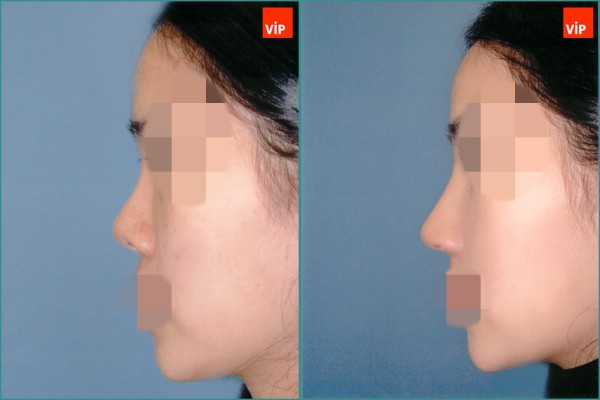 Nose Surgery - Septal cartilage rhinoplasty