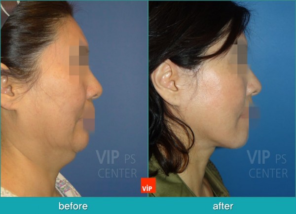 Face Lift - High SMAS Face / Necklift