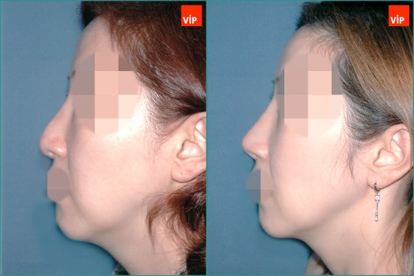 Nose Surgery - Septal cartilage rhinoplasty