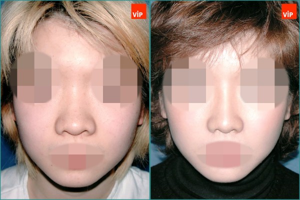 Nose Surgery - Septal cartilage rhinoplasty