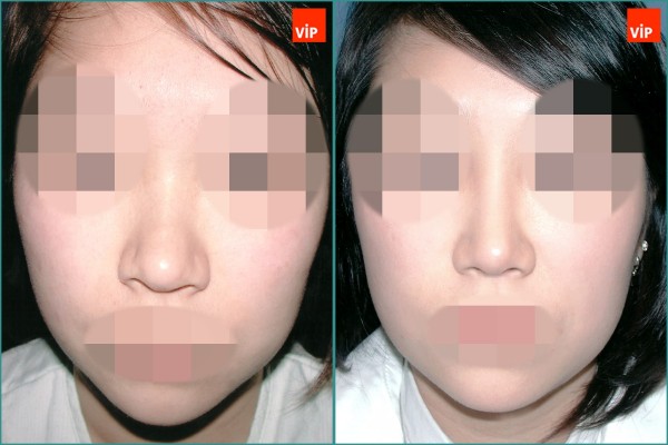 Nose Surgery - Septal cartilage rhinoplasty