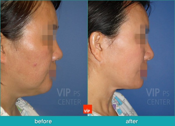 Face Lift - High SMAS Face / Necklift