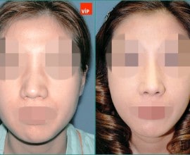 Septal cartilage rhinoplasty