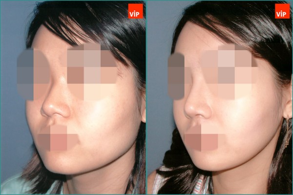 Nose Surgery - Septal cartilage rhinoplasty