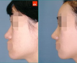 Septal cartilage rhinoplasty