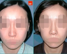 Septal cartilage rhinoplasty