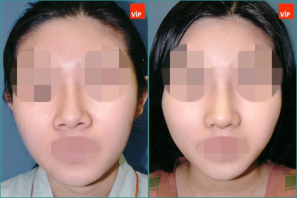 Nose Surgery - Septal cartilage rhinoplasty