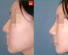 Septal cartilage rhinoplasty