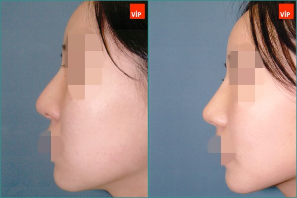 Nose Surgery - Septal cartilage rhinoplasty