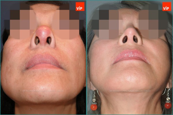Nose Surgery - Face lift / Revision rhinoplasty / Rib cartilage rhinoplasty