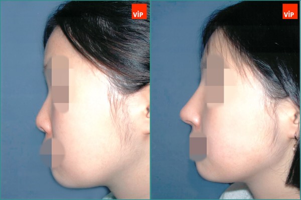 Nose Surgery - Rib cartilage rhinoplasty