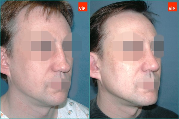 Nose Surgery - Hump Nose Septal cartilage rhinoplasty, Mid Face Augmentation
