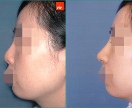 Septal cartilage rhinoplasty