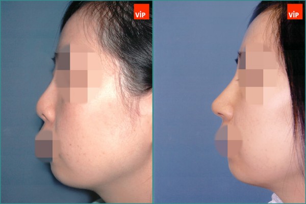 Nose Surgery - Septal cartilage rhinoplasty