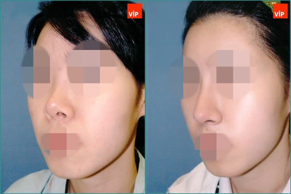 Nose Surgery - Rib cartilage rhinoplasty