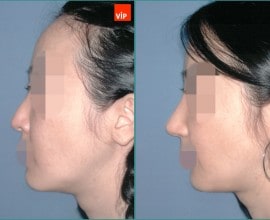 Septal cartilage rhinoplasty