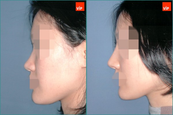 Nose Surgery - Septal cartilage rhinoplasty