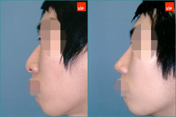 Nose Surgery - Hump nose