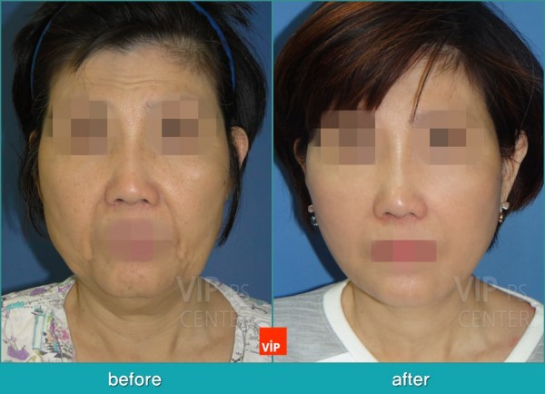 Face Lift - High SMAS Face / Necklift