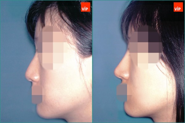 Nose Surgery - Septal cartilage rhinoplasty