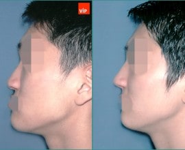 Rib cartilage rhinoplasty