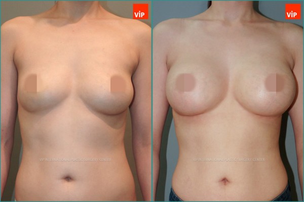 Breast Surgery - Breast Surgery